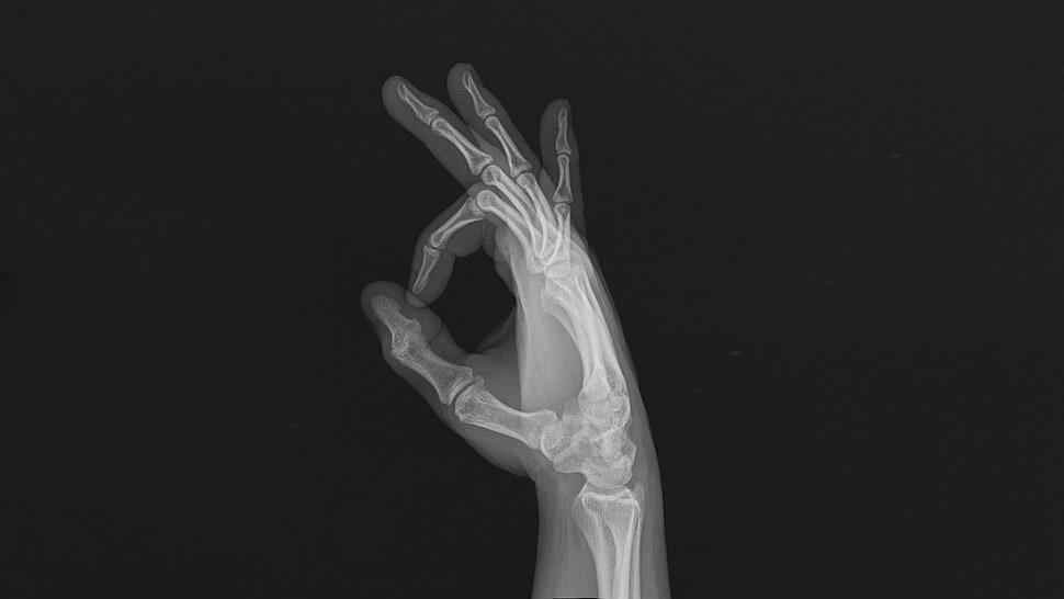 hand x-ray result, hands, bones, x-rays, fingers HD wallpaper