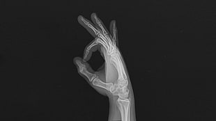 hand x-ray result, hands, bones, x-rays, fingers HD wallpaper