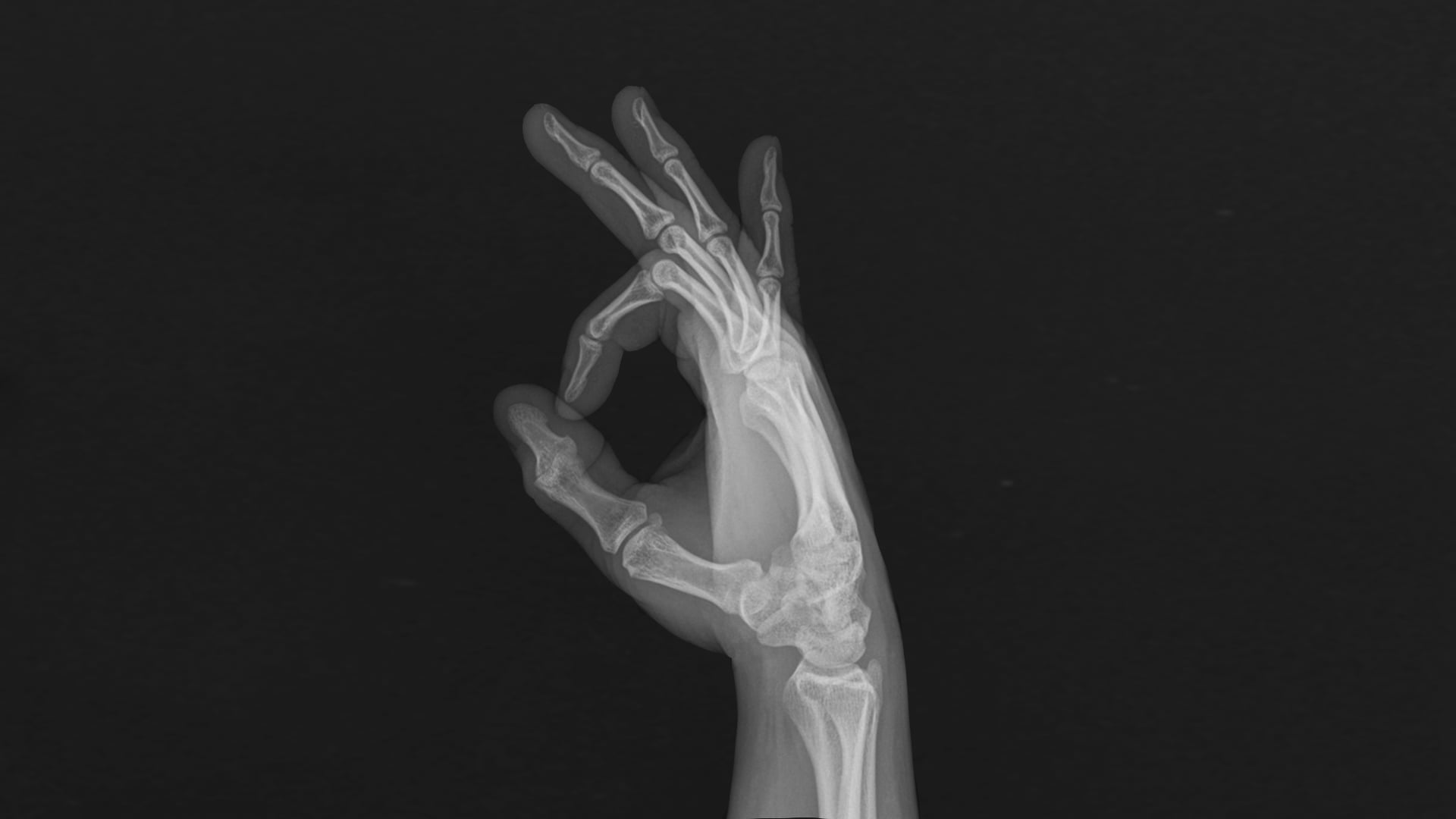 hand x-ray result, hands, bones, x-rays, fingers